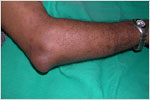 Olecranon Bursitis in Gout, click here to see large picture.