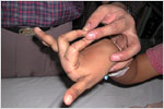 Hypermobile Joints, click here to see large picture.