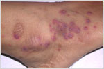 Rash in Wegener�s Granulomatosis, click here to see large picture.