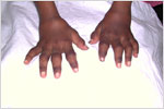 Arthritis in a Child (JRA), click here to see large picture.