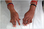 Rheumatoid Arthritis, click here to see large picture.