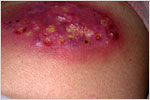 Vasculitic Ulcer in Rheumatoid Arthritis, click here to see large picture.