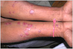 Psoriasis in Psoriatic Arthritis, click here to see large picture.