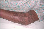 Subacute Cutaneous Lupus, click here to see large picture.