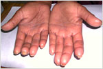 Hands in Scleroderma, click here to see large picture.