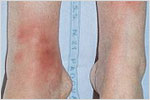 Erythema Nodosum Rash in Reactive Arthritis, click here to see large picture.
